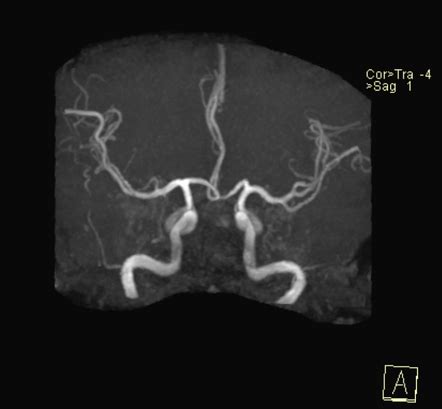 Normal Head Mr Angiogram Radiology Case Radiopaedia Org