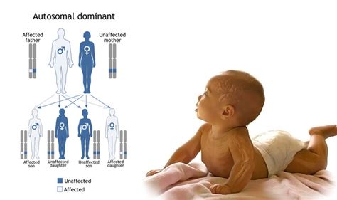 What Is Q Deletion Syndrome Storymd