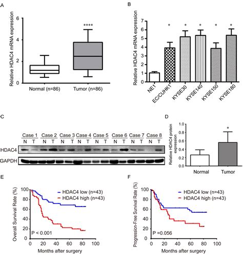 Overexpressed HDAC4 Is Associated With Poor Survival And Promotes Tumor