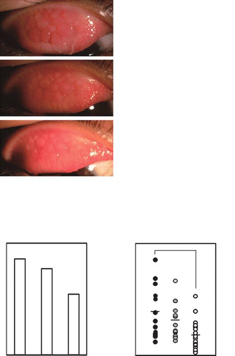 Case 3 A Patient With Vernal Conjunctivitis The Size Of Total And Each Download Scientific