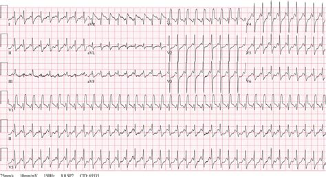 ECG during rapid palpitations | Download Scientific Diagram