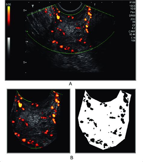 Power Doppler Vascularity Index For Digital Tumor Vascularization