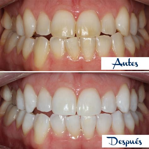 Blanqueamiento Dental Antes Y Despu S Teeth