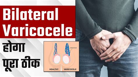 Bilateral Varicocele होगा पूरा ठीक Non Surgical Treatment Of