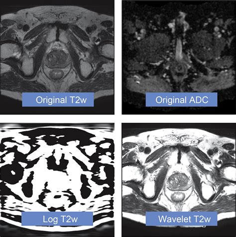 Changes In Adc And T Weighted Mri Derived Radiomic Features In