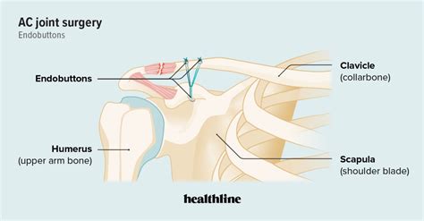 AC Joint Surgery: Types, Costs, and Recovery