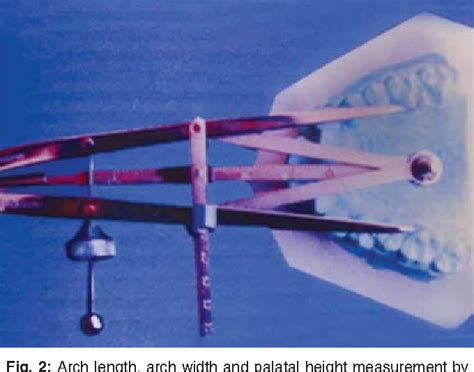 Figure 2 From Relationship Between Dental Arch Dimensions And Vertical