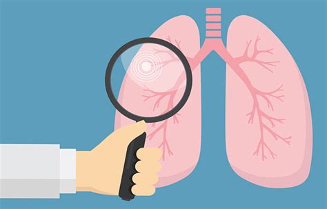 Centralized Lung Cancer Screening Programs Improve Adherence Jama