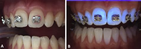 Clinical Effect Of A Fluoride Releasing And Rechargeable Primer In