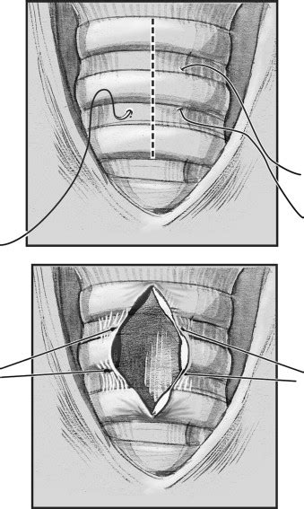 Operative Tracheotomy Operative Techniques In Otolaryngology Head And