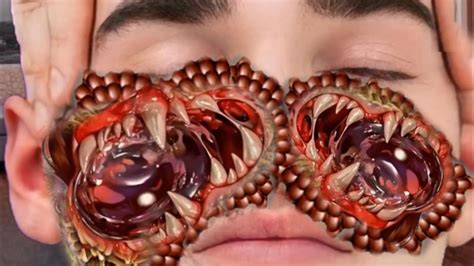 Asmr Treatment Infected Chin Maggot Removal And Trypophobia Worm