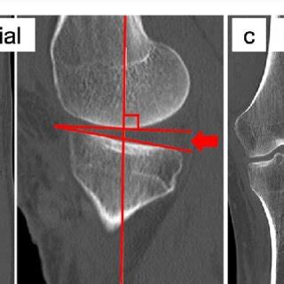 Posterior Tibial Slope PTS Measurements Using CT Images The Arrow