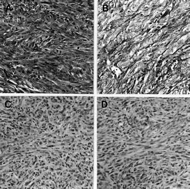 PLD1 And PLD2 Transfected Cells Induce Undifferentiated Sarcomas In