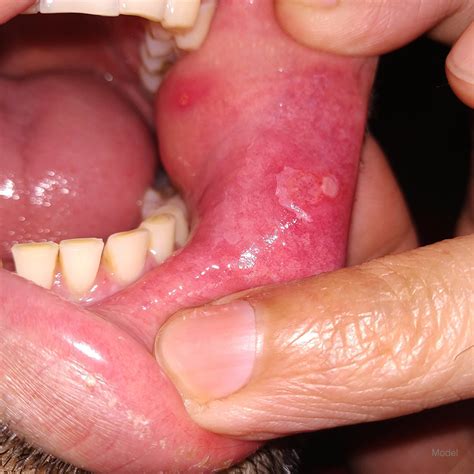 Oral Cancer Tongue