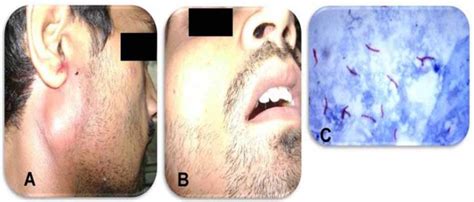 Parotid Gland Tuberculosis Presentation Of 4 Case Variants Semantic