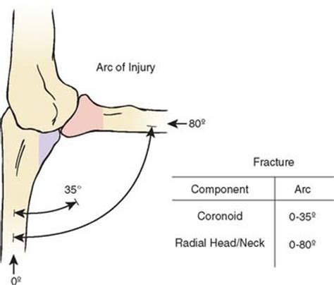 Radial Head Fracture | Musculoskeletal Key