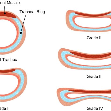 Different Degrees Of Tracheal Collapse According To The Collapse Of The