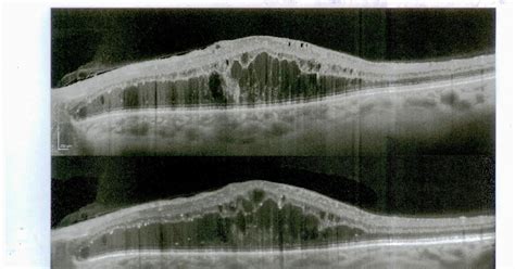 British Journal Of Ophthalmology V 104 I 06 Lrc