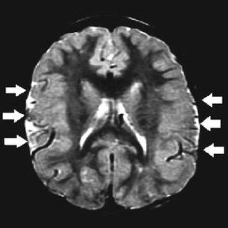 Brain MRI (sagittal view — T1 weighted): herniation of the cerebellar ...