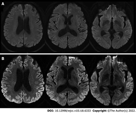 Findings Of Brain Magnetic Resonance Imaging A The Initial Brain Download Scientific Diagram