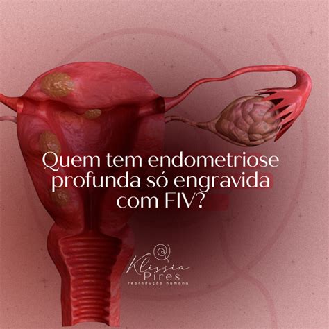 Quem Tem Endometriose Profunda S Engravida Fiv Dra Klissia