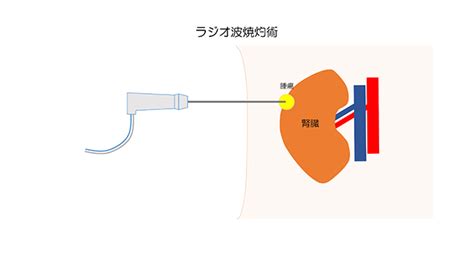 小径腎がんに対するラジオ波焼灼術について 国立がん研究センター 東病院