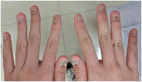 Full Article Upadacitinib In Nail Psoriasis A Case Report