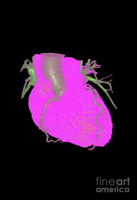 Coronary Artery Disease By Vsevolod Zviryk Science Photo Library