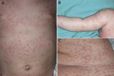 Generalized Eruptive Histiocytosis Perri Dermatology