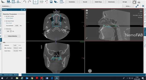 Evaluating The Changes In Nasal Airway Volume And Nasal Airflow After