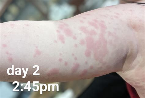 Amoxicillin rash progression : r/DermatologyQuestions