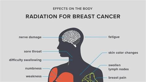 Understanding and Managing Side Effects of Radiation Therapy in Breast Cancer Treatment