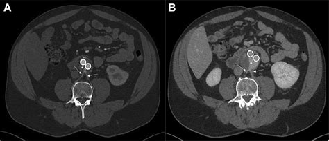 Effective Treatment Of Type Iib Endoleak Via Targeted Translumbar