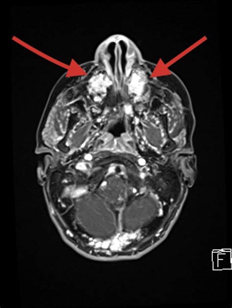 axial view   maxillary lesion  scientific diagram