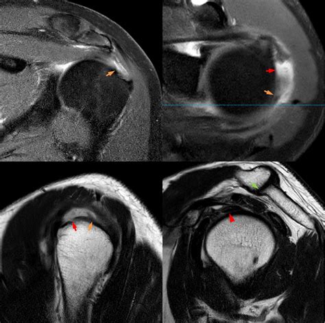 Full Thickness Rotator Cuff Tears Value Of Clinical Tests Porn Sex