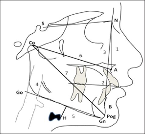 Cephalometric Variables Measured 1 Sna Angle Between Sella Nasion Download Scientific