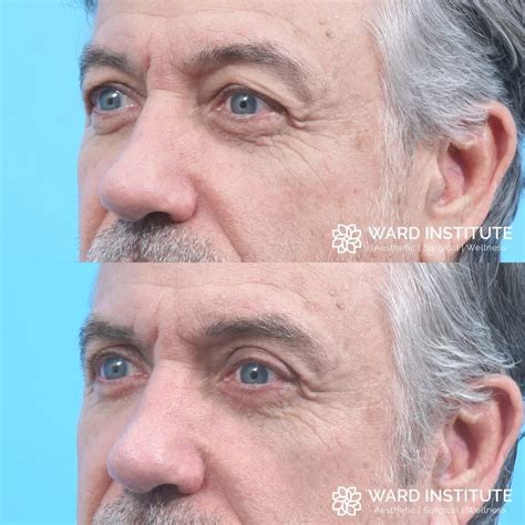 Blepharoplasty Before And After Photo Patient 05 Ward Institute