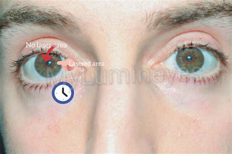 Before And After Photos Of Laser Eye Color Change Surgery