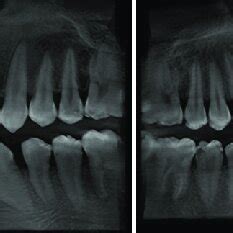 Cone Beam Computed Tomography Assessment Right At The Time Of