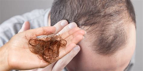 Disease Cause Hair Loss