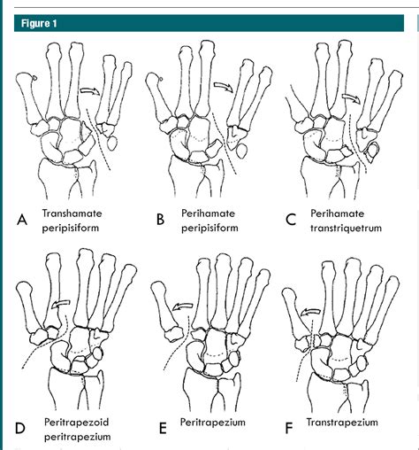 Figure 1 From Traumatic Axial Dislocation Injuries Of The Wrist