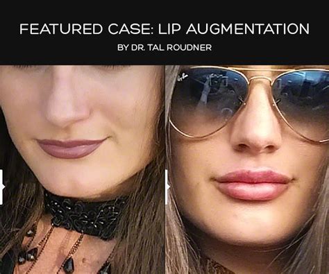 Lip Augmentation In Miami By Dr Tal T Roudner Md