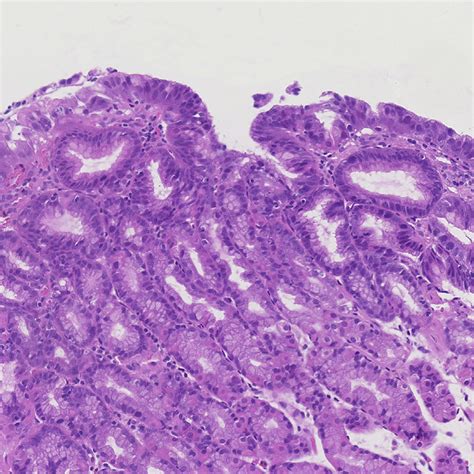 Overview Of Gastric Epithelial Polyps Classified By Cell Or Epithelial