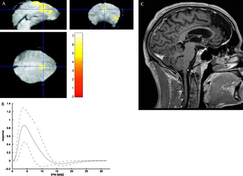 Eeg Correlated Functional Mri And Postoperative Outcome In Focal