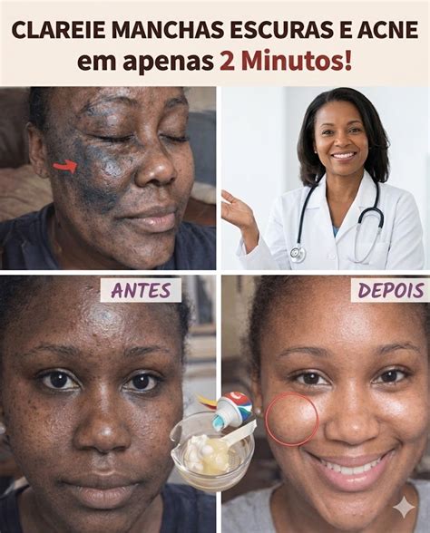 Vaselina No Rosto Antes E Depois - APLIQUEI PASTA DE DENTE COLGATE E VASELINA NO ROSTO — VEJA O QUE ...