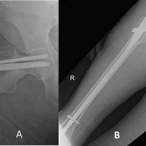 A Right Hip Radiograph 3 Weeks After Index Surgery Demonstrating A