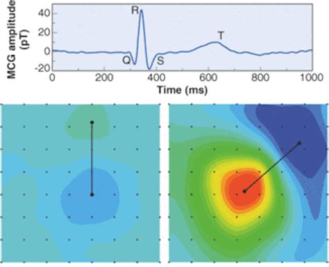 Optical magnetometer maps the heart | Laser Focus World