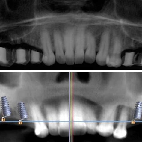 Cone Beam Computerized Tomography Assessment A Preoperative