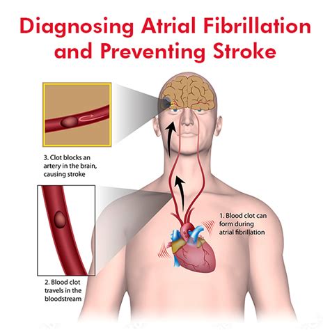 Diagnosing Atrial Fibrillation And Preventing Stroke Dr Raghu