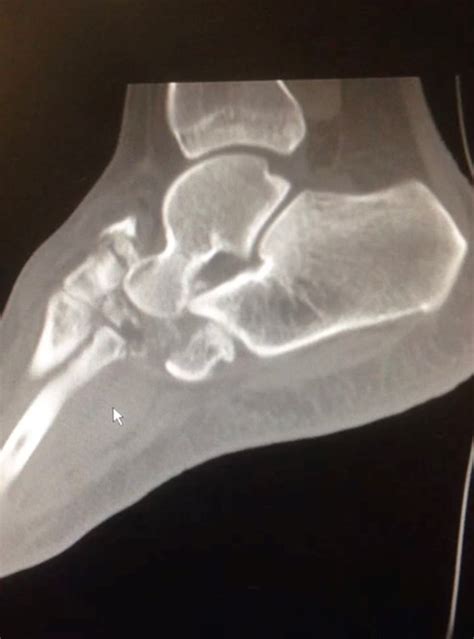 Foot & Ankle Fractures – Flex Foot & Ankle